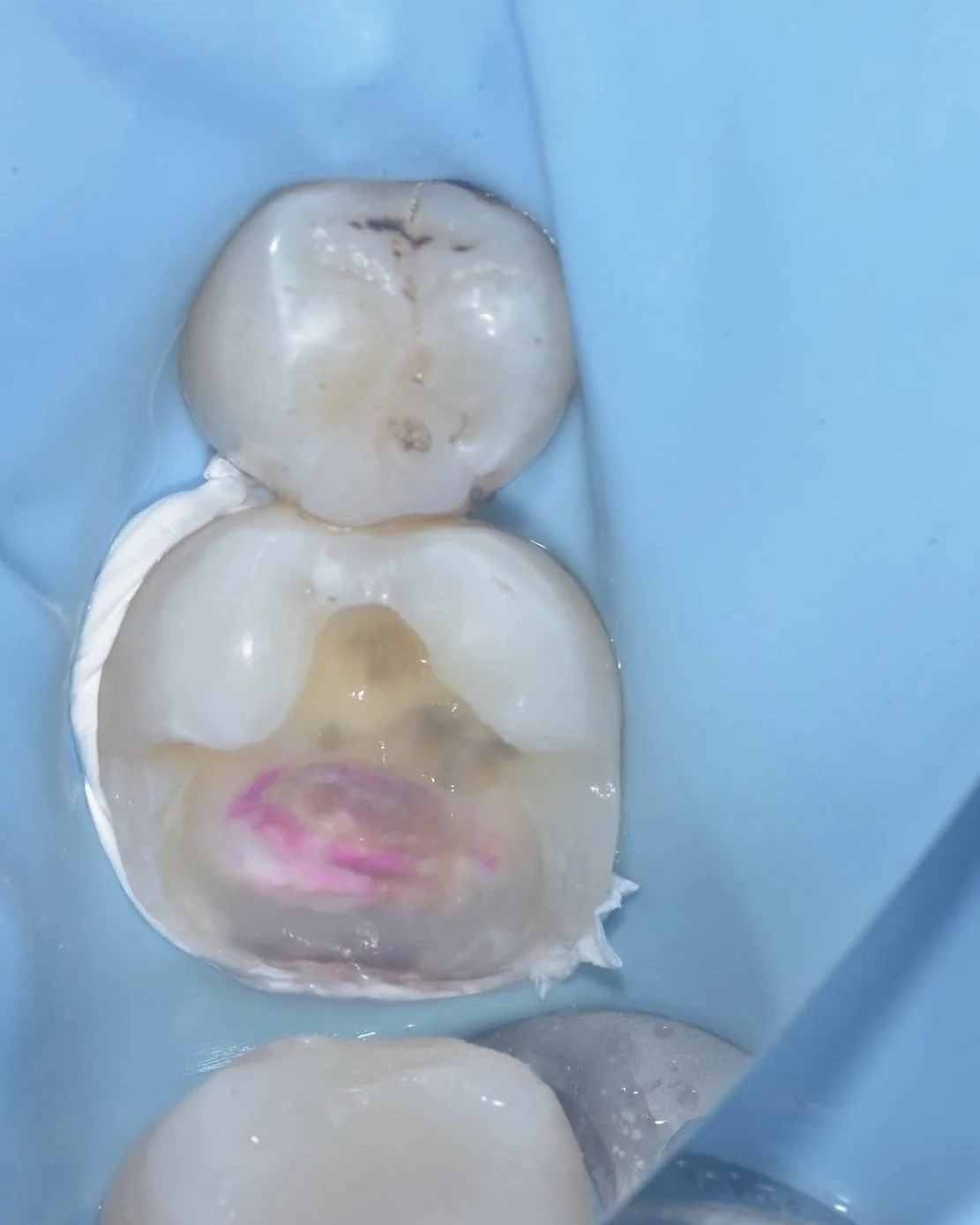 Caries removal endpoints case Davey Alleman 2.jpg