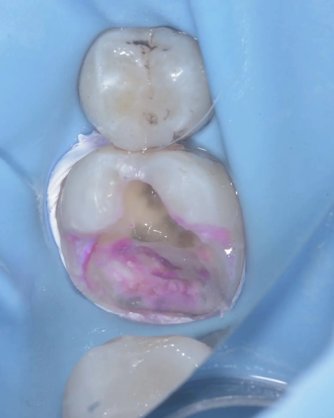 Caries removal endpoints case Davey Alleman 1.jpg