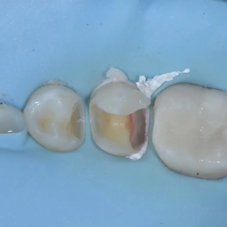 Treat post operative sensitivty davey alleman 3.jpg