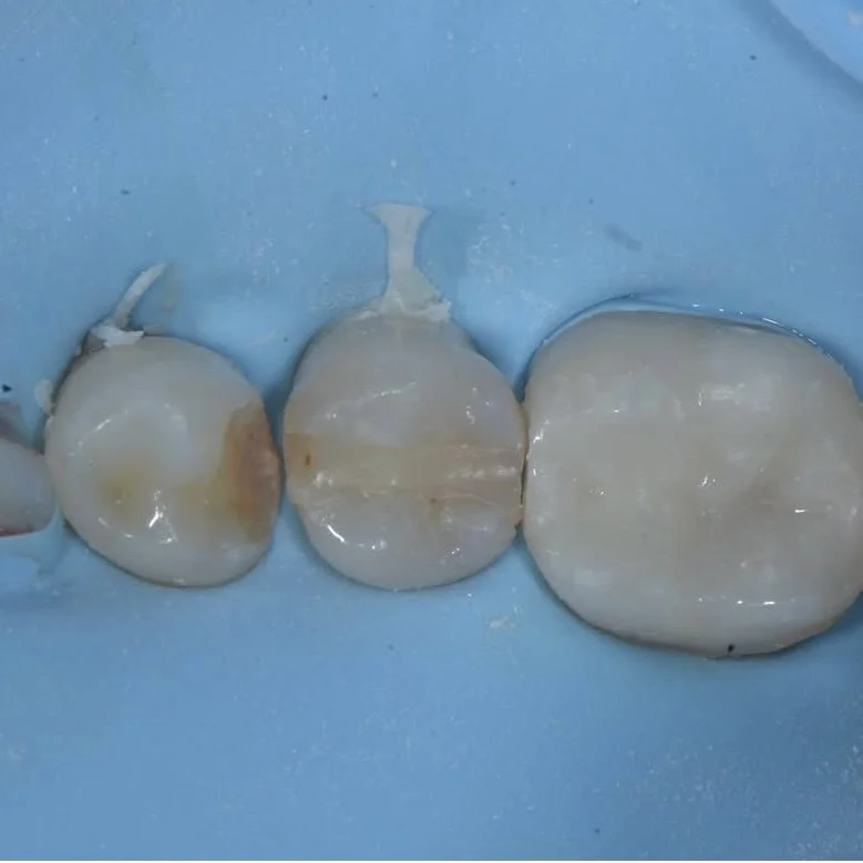 Treat post operative sensitivty davey alleman 1.jpg