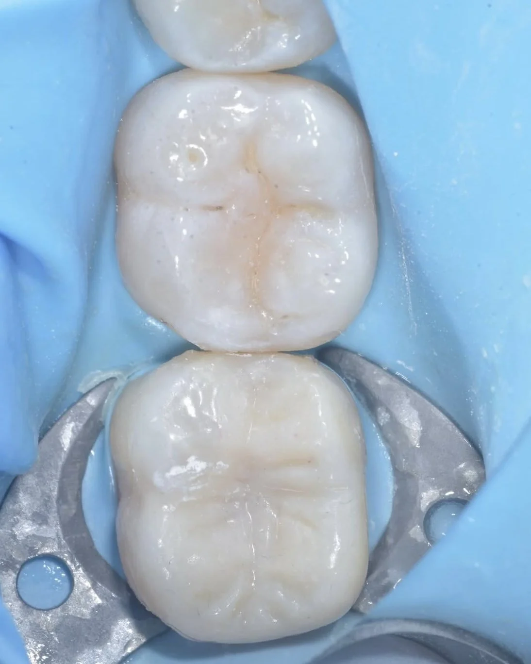 Biomimetic treatment peripheral rim fracture 7.jpg