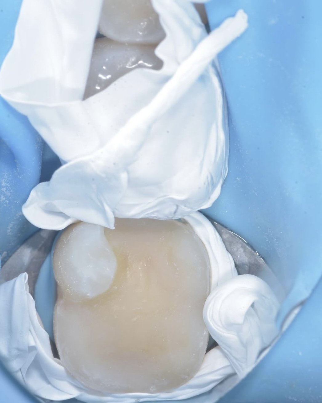Biomimetic treatment peripheral rim fracture 6.jpg