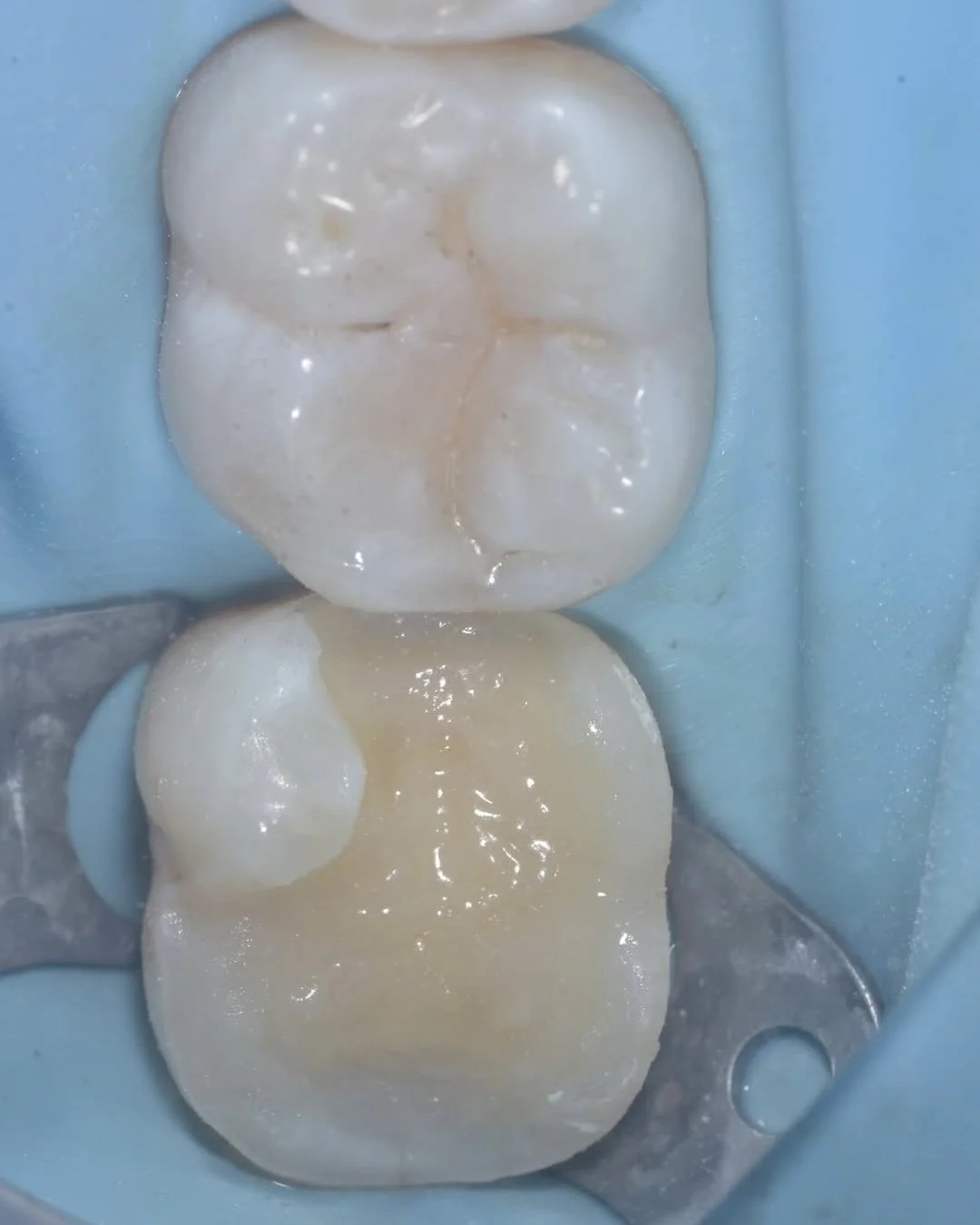 Biomimetic treatment peripheral rim fracture 5.jpg