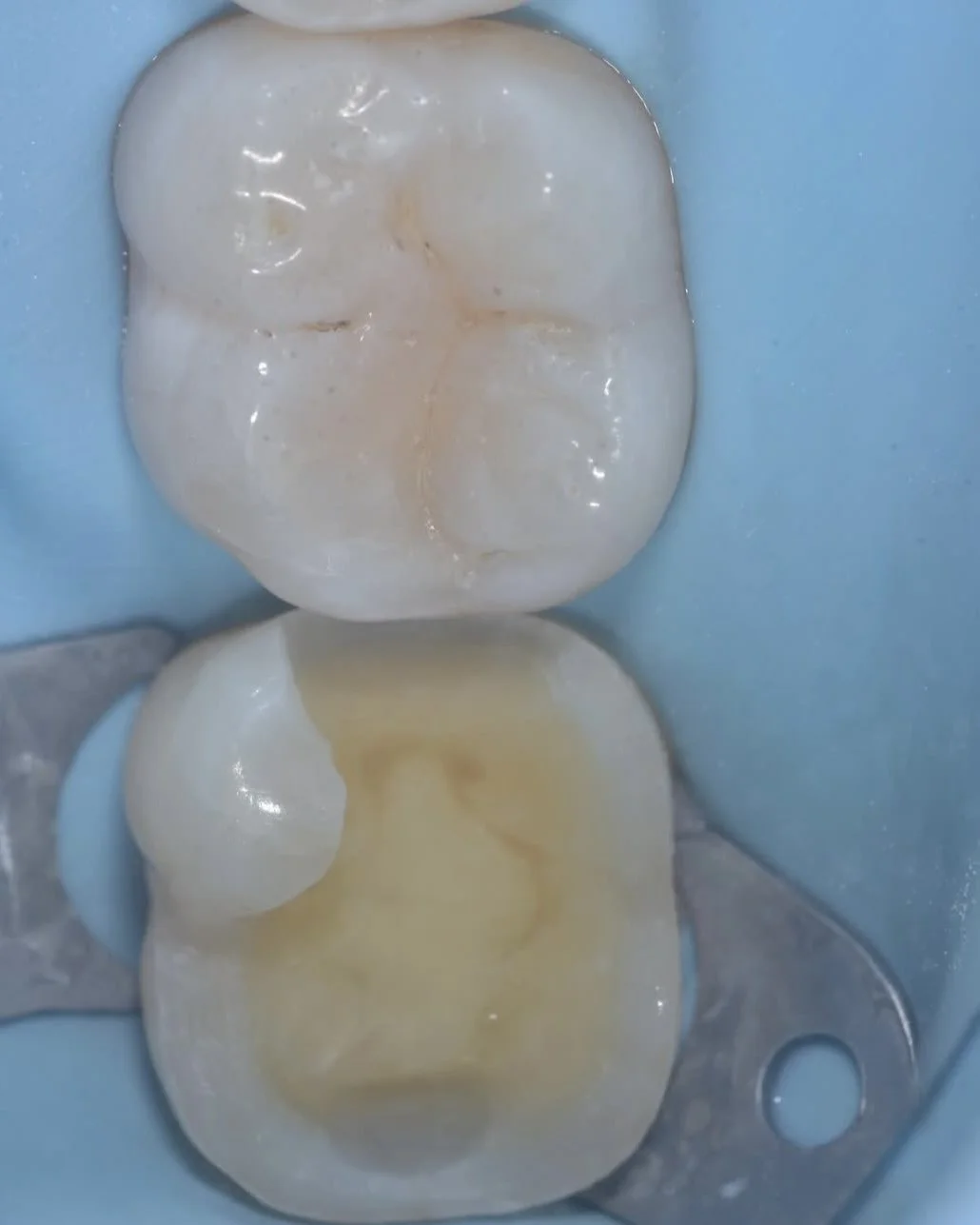 Biomimetic treatment peripheral rim fracture 4.jpg