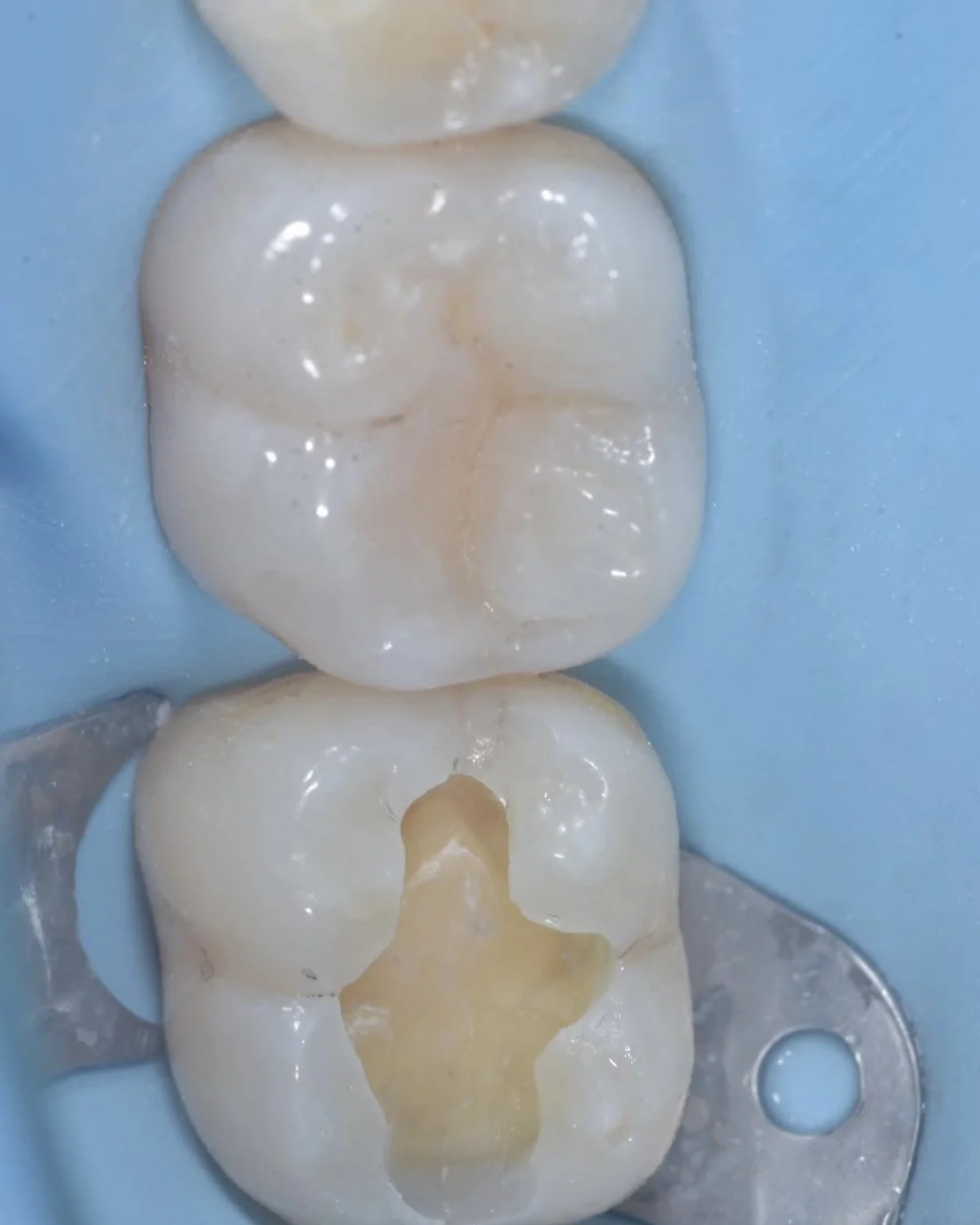 Biomimetic treatment peripheral rim fracture 3.jpg