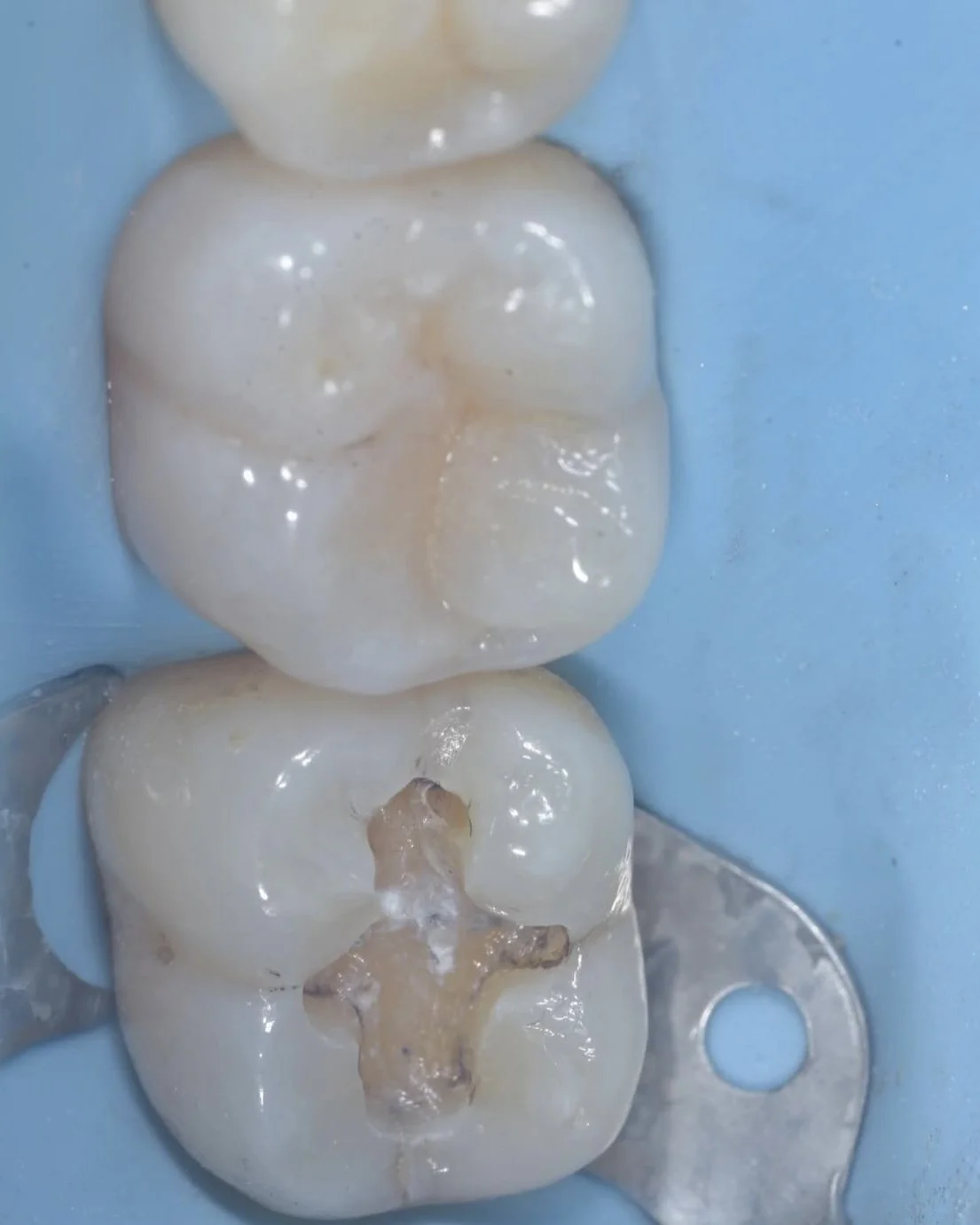 Biomimetic treatment peripheral rim fracture 2.jpg