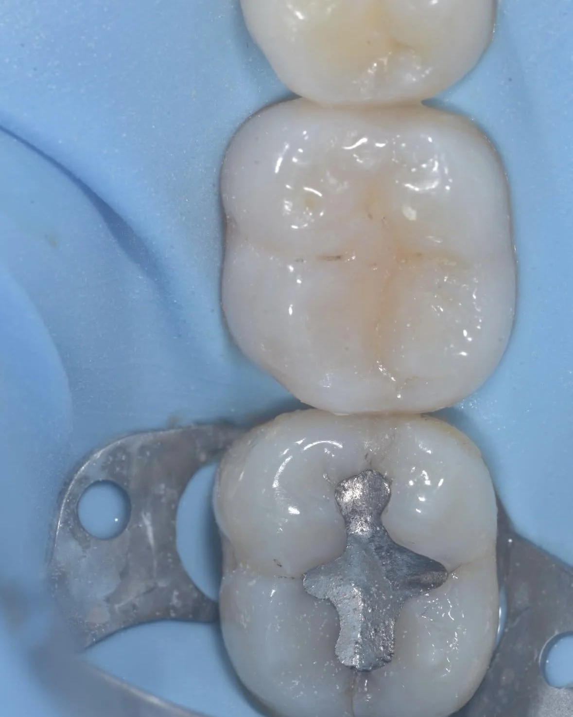 Biomimetic treatment peripheral rim fracture 1.jpg