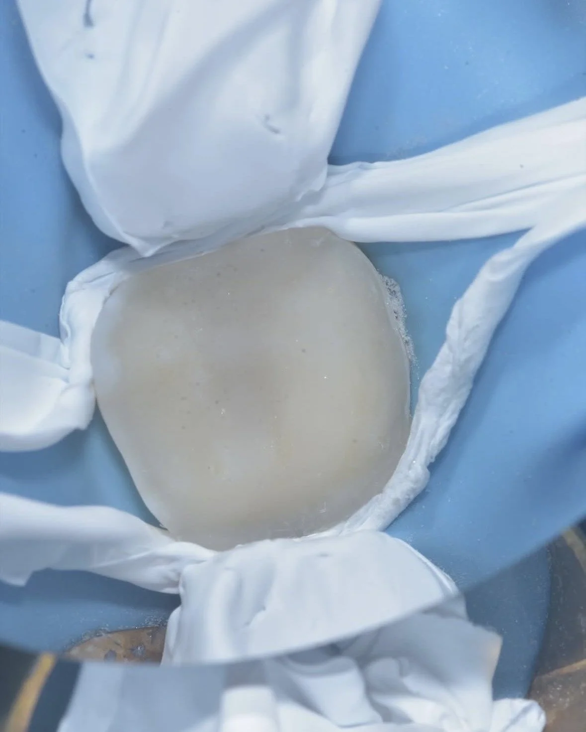 Biomimetic restoration endodontically treated tooth case example 6.jpg