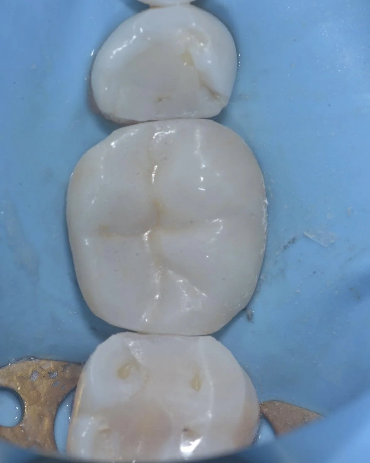 Biomimetic restoration endodontically treated tooth case example 7.jpg