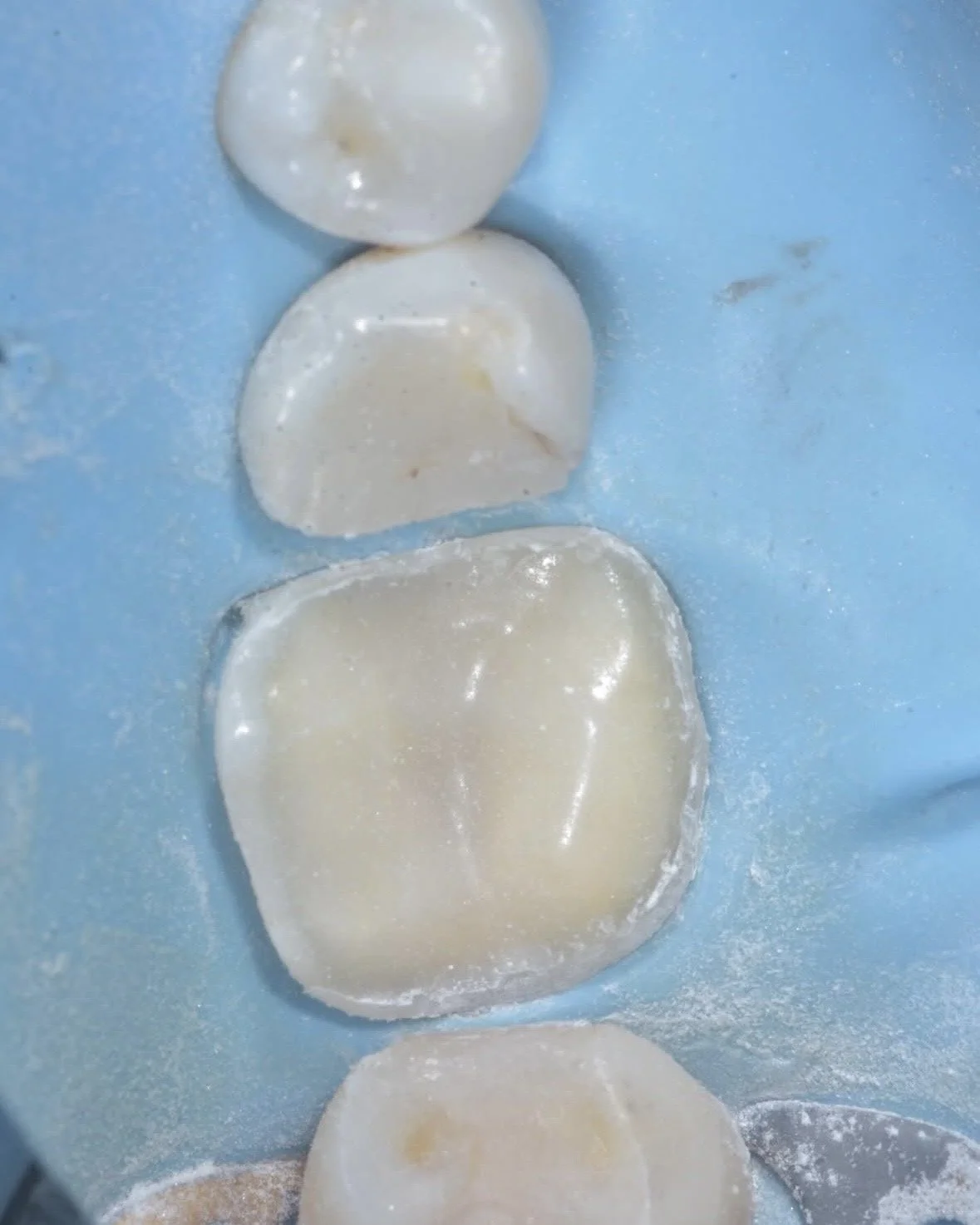 Biomimetic restoration endodontically treated tooth case example 5.jpg