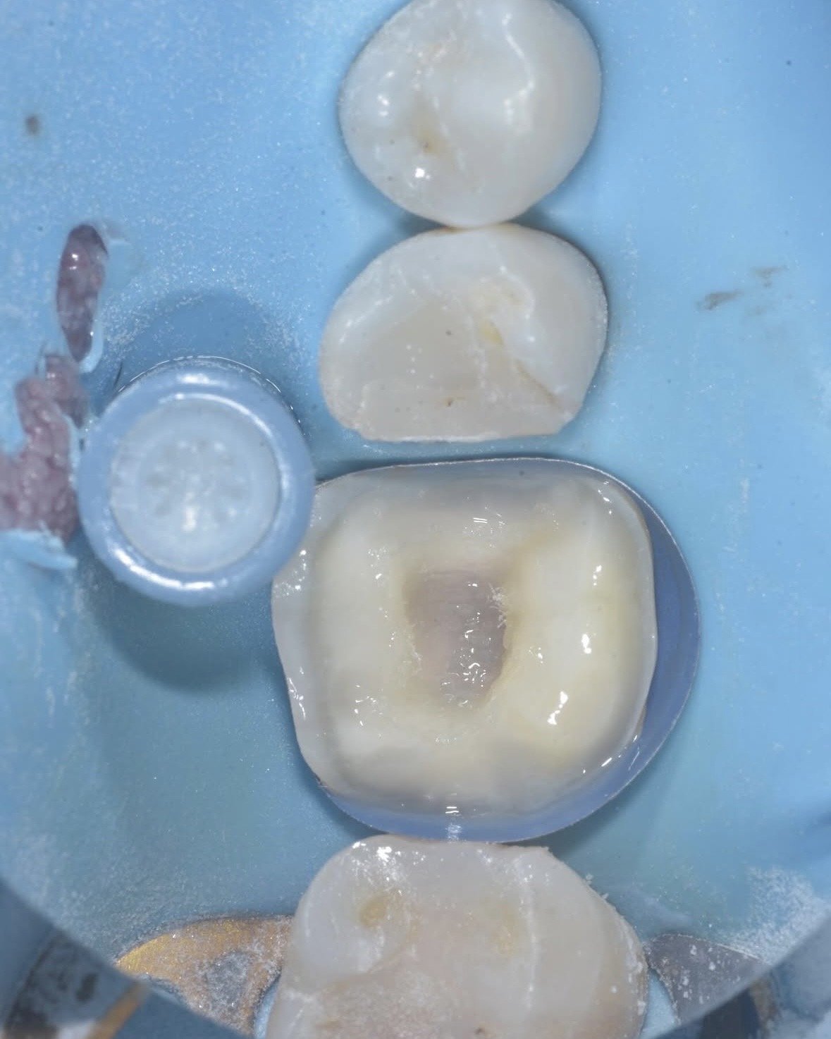 Biomimetic restoration endodontically treated tooth case example 4.jpg