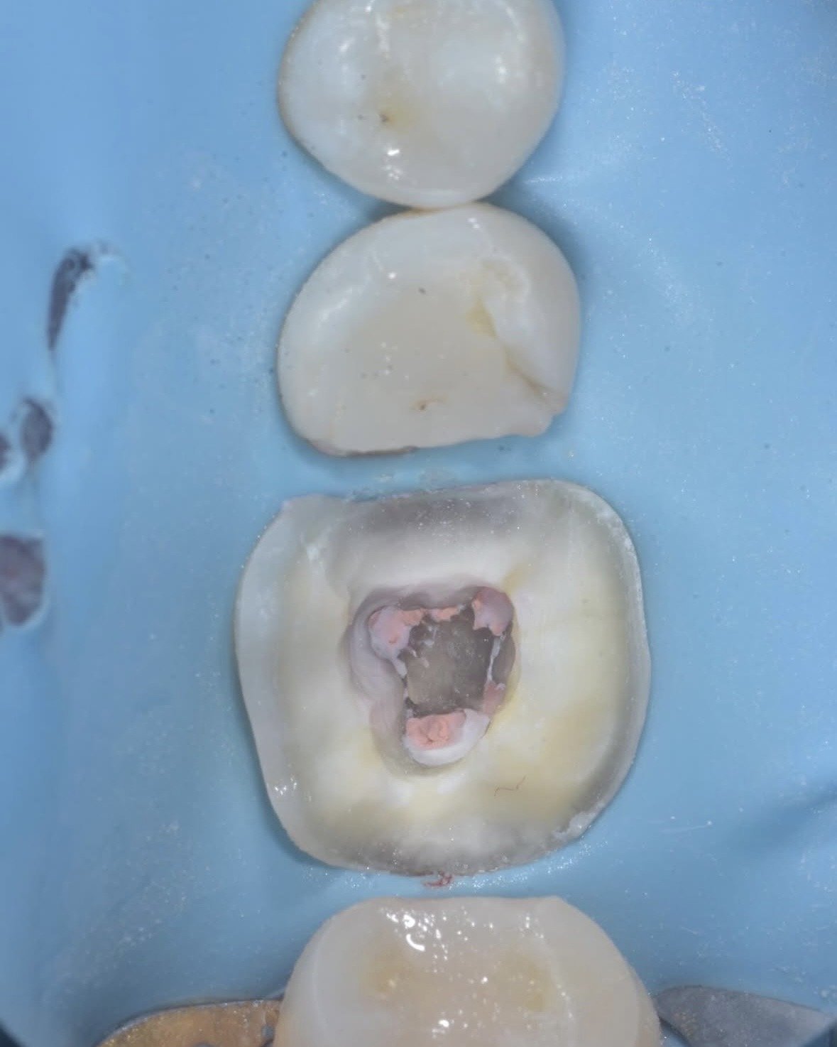 Biomimetic restoration endodontically treated tooth case example 3.jpg