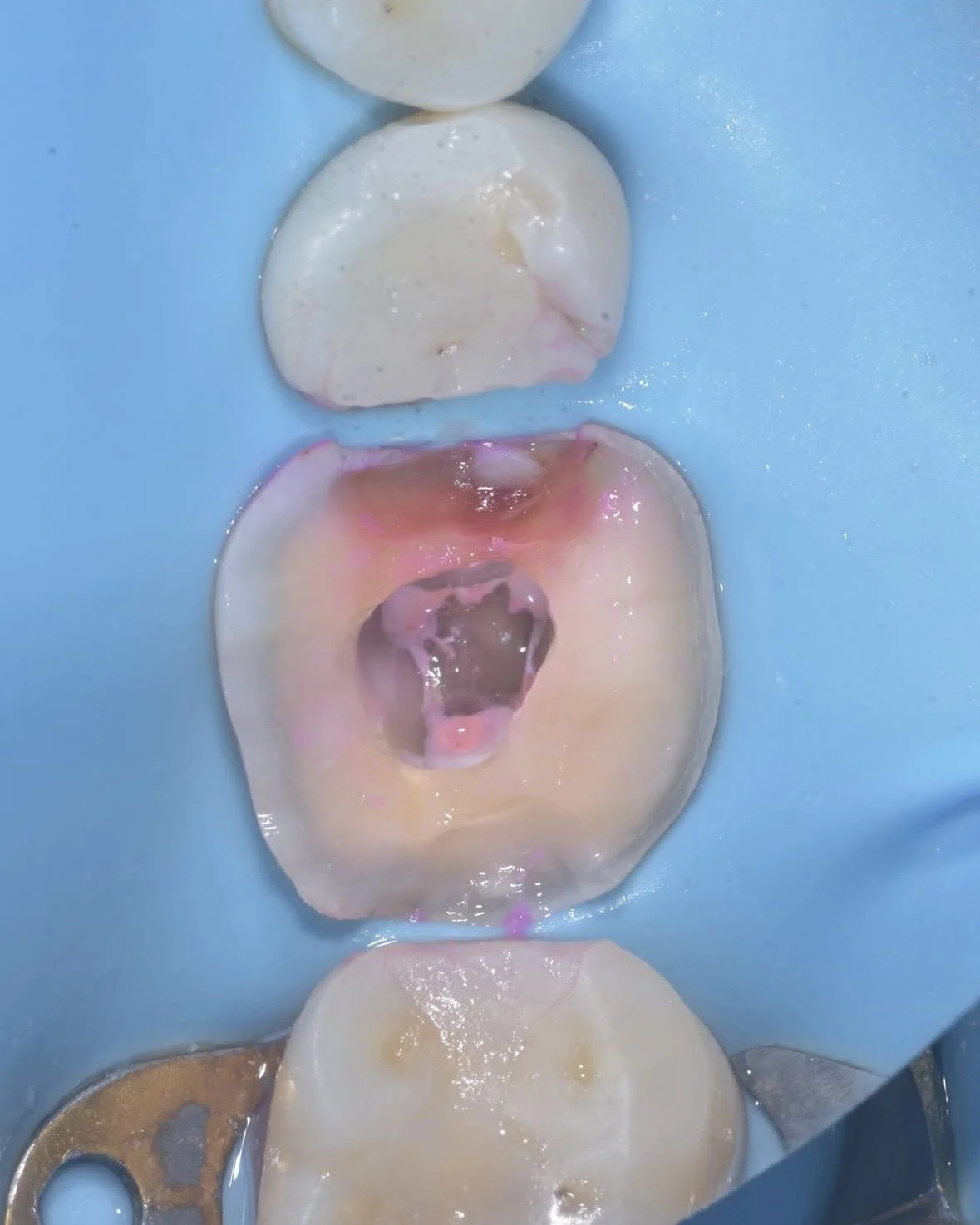 Biomimetic restoration endodontically treated tooth case example 2.jpg