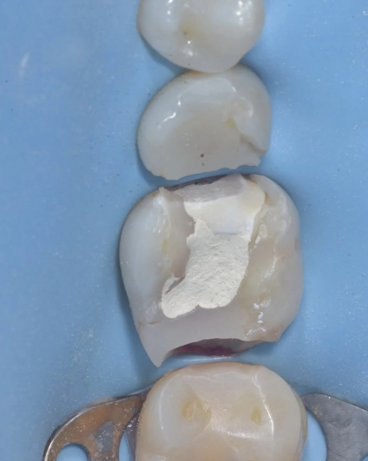Biomimetic restoration endodontically treated tooth case example 1.jpg