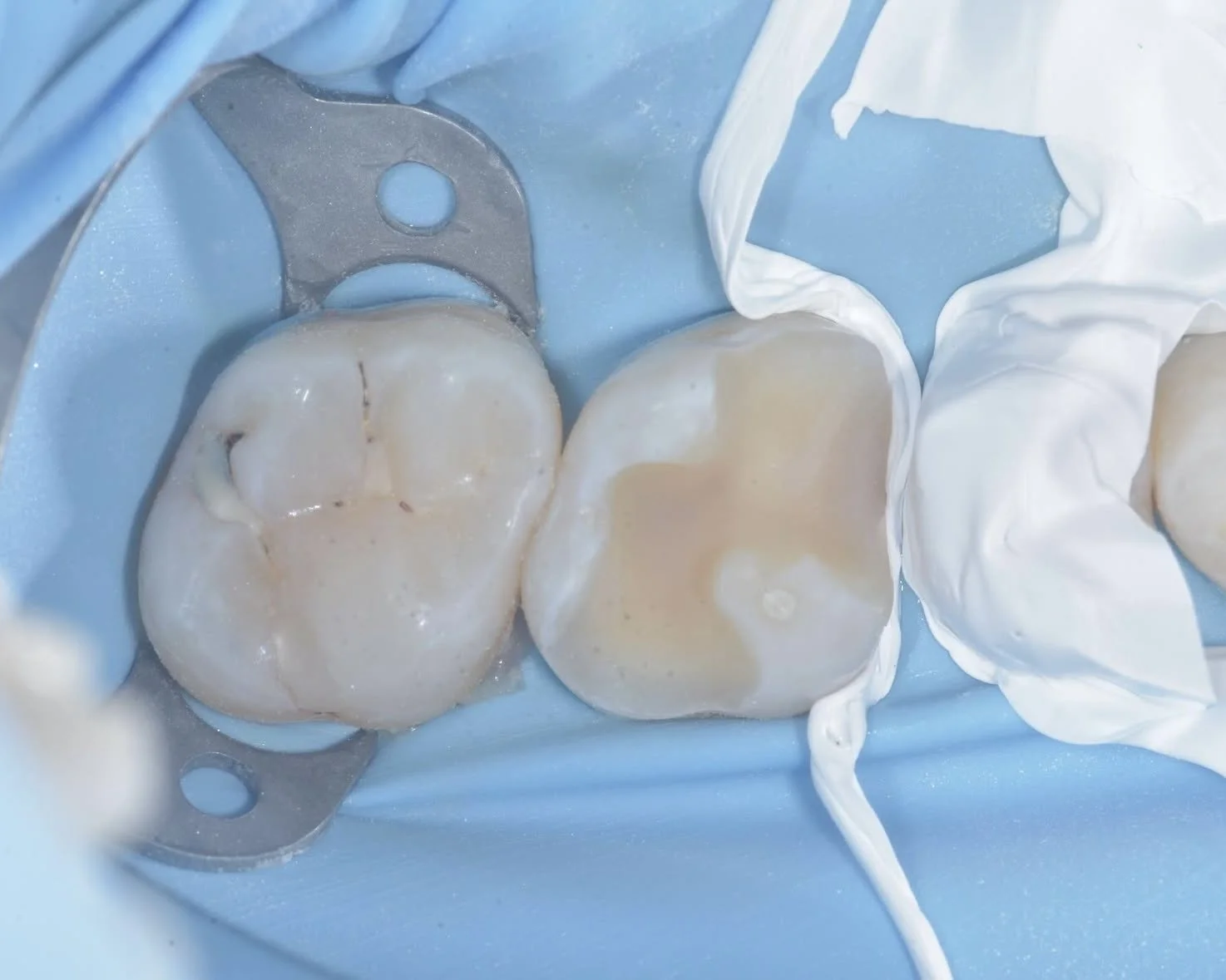 Rubber Dam Isolation for Improved Dental Bonding