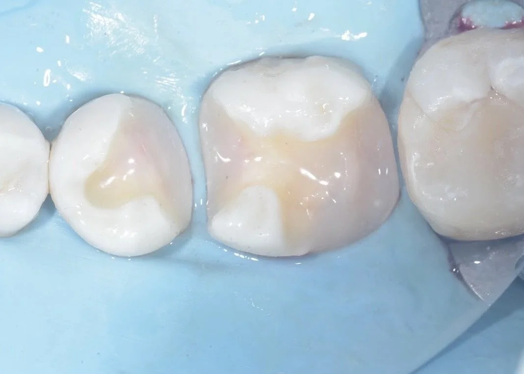 Biobase: Dentin Replacement in a Biomimetic Restoration