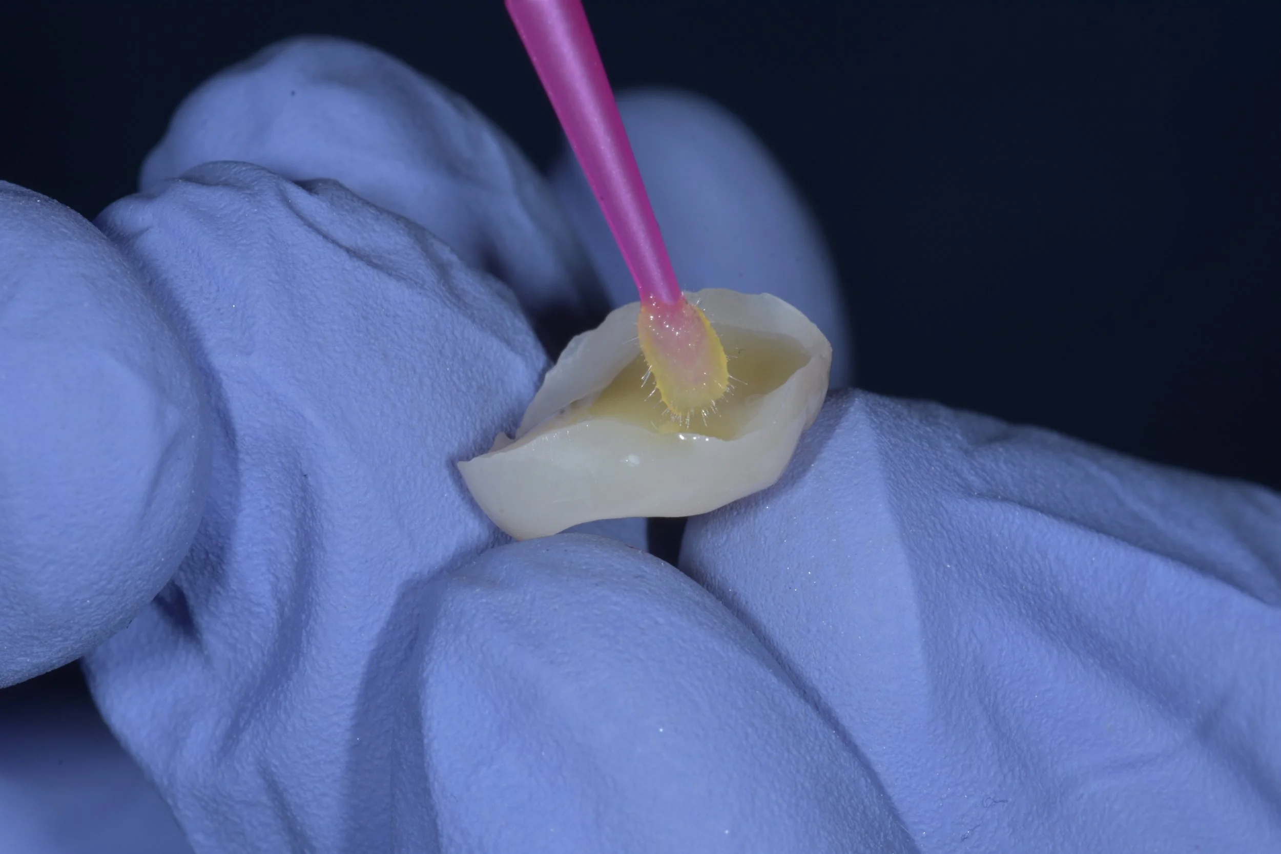 Dental Onlays, Inlays and Overlays: Predictable Fabrication and Bonding ...