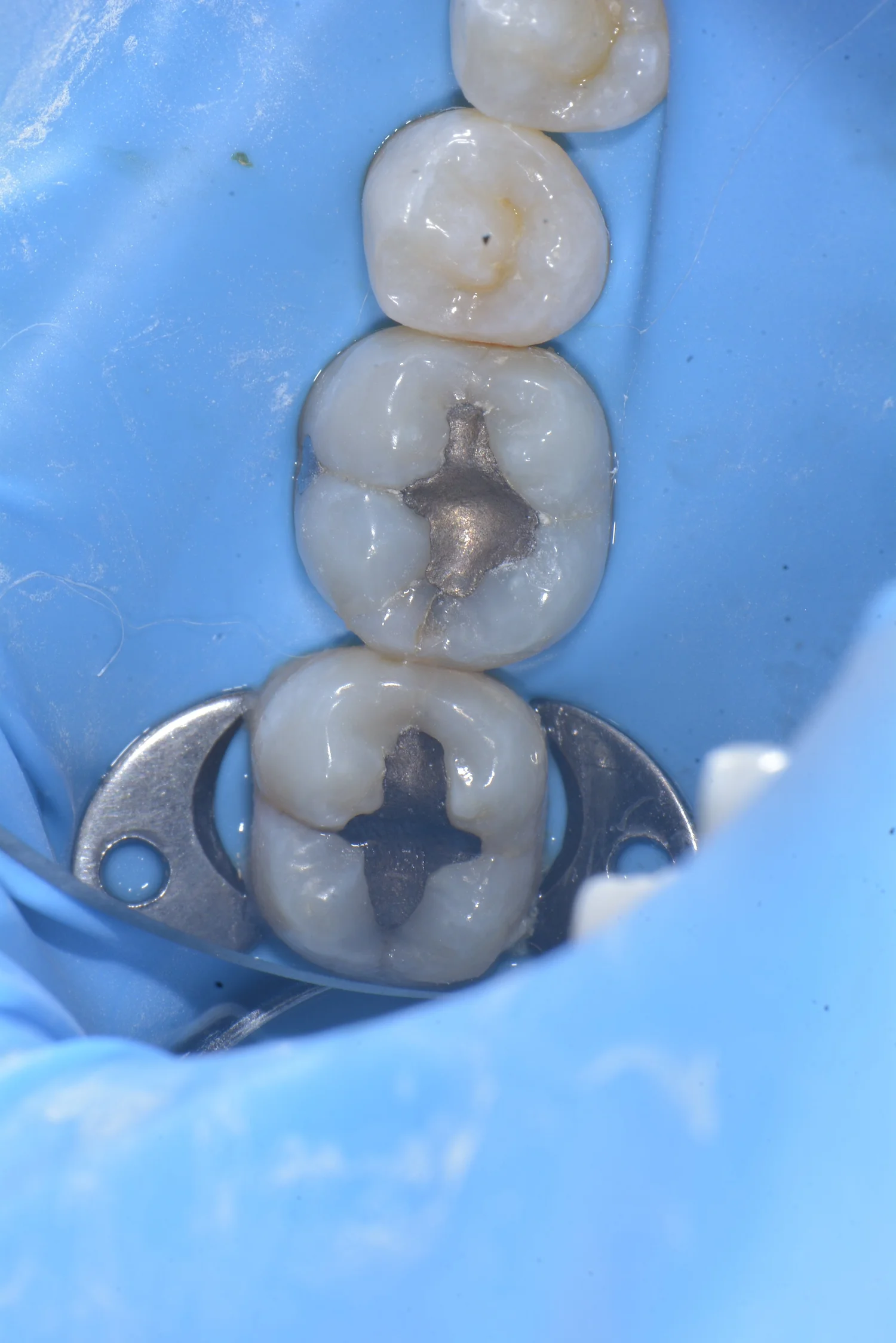Peripheral Rim Fractures and Occlusal Effect Caries in Teeth — Alleman ...