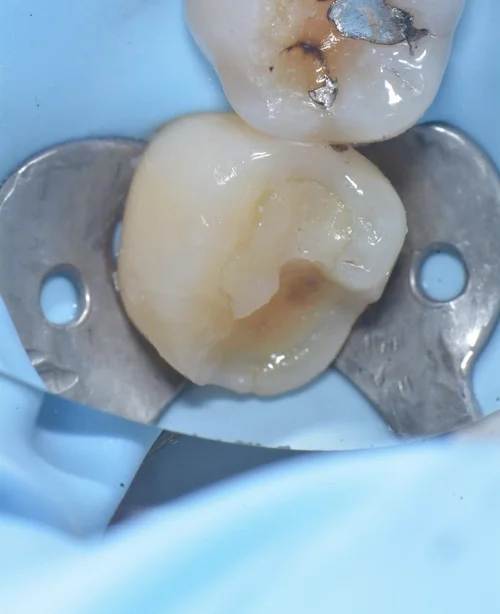 Treating Different Types of Cracks in Teeth — Alleman Center of ...