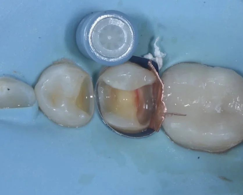 Dentin Restoration: How to Trust Your Bond to Dentin