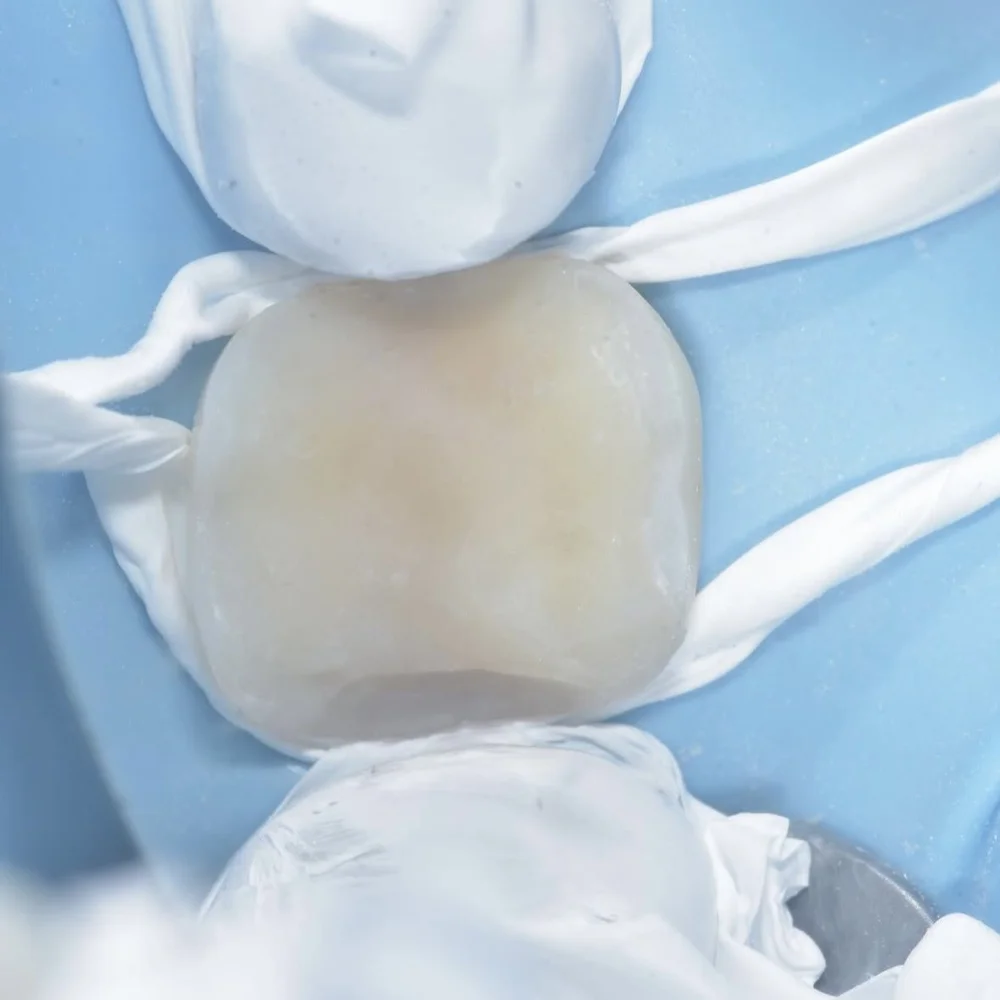 Enamel Modification How to Choose an Enamel Replacement — Alleman Center of Biomimetic ...