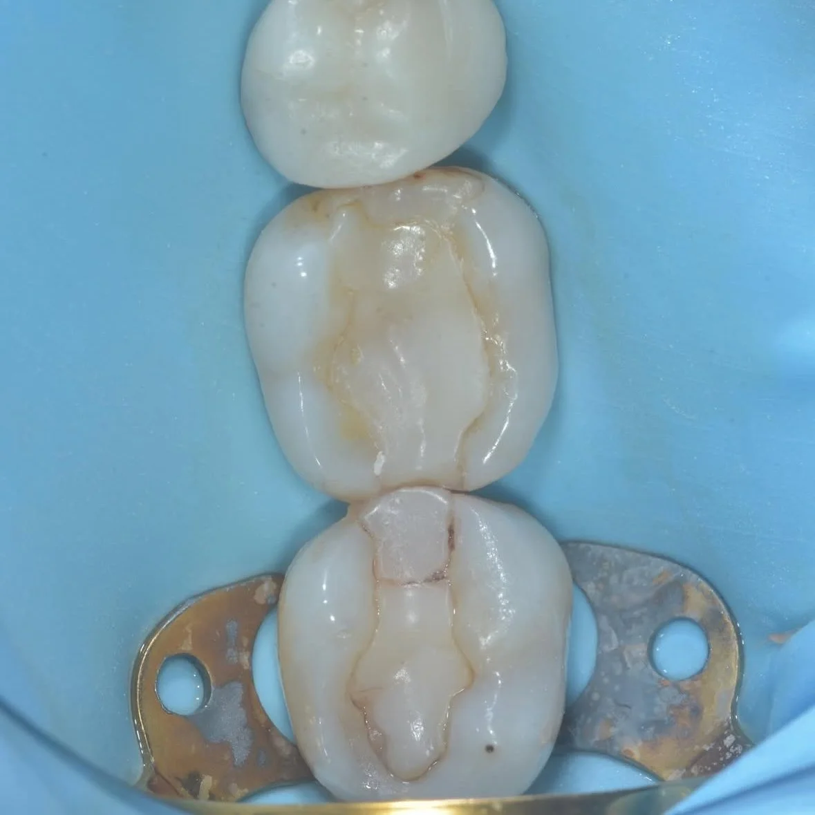 Tooth Flexure, Crack Initiation and Abfraction Lesions — Alleman Center ...