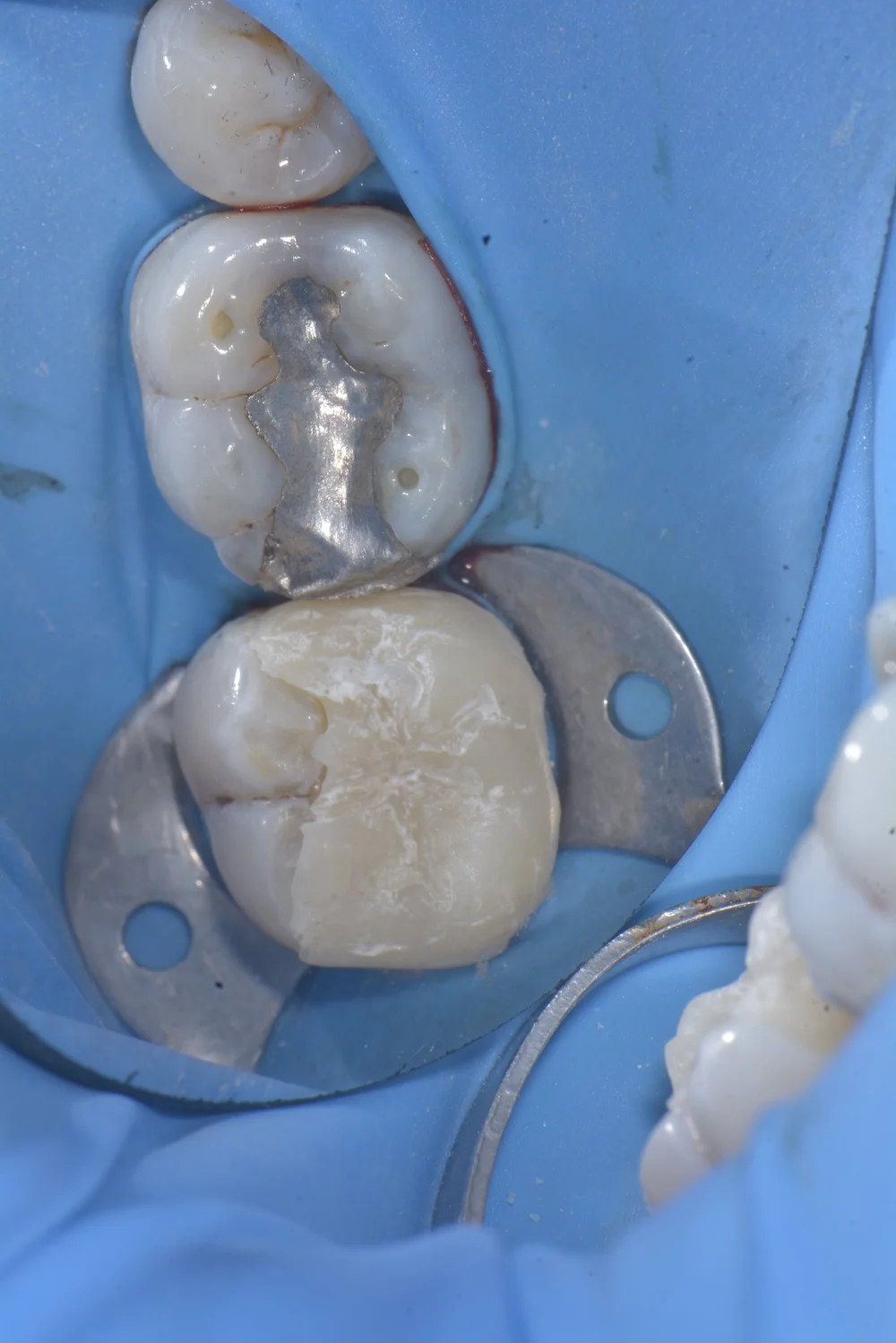 Base Metal Inlay Dental Onlays, Inlays and Overlays: Predictable Fabrication and Bonding ...