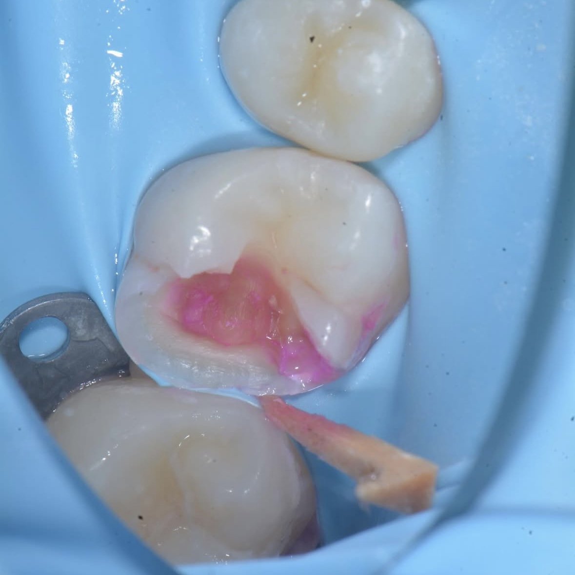 Caries Detector Dye (CDD): Increase Bond Strength and Protect the Pulp
