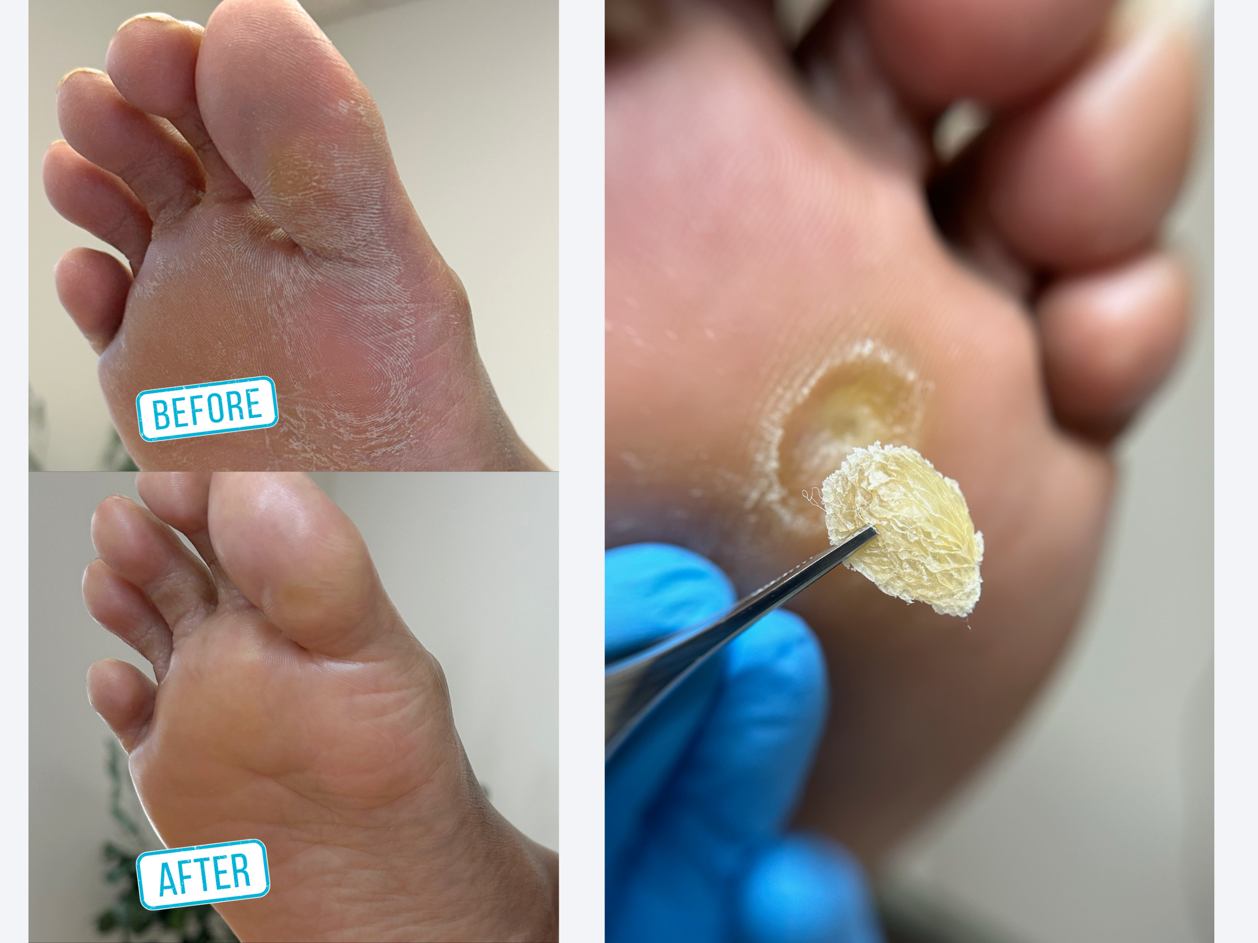 Comparison of a foot before and after callus removal. The 'before' shows dry, rough, and thickened skin with white patches. The 'after' shows smooth, clean skin with a tool removing a yellowish callus.