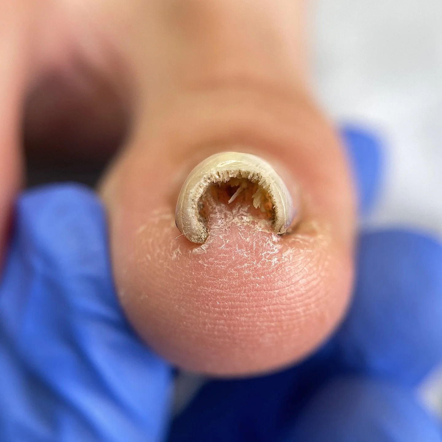 An interesting progression of a deformed toenail 👣

In this case, we corrected the nail deformation using a titanium wire system.

A titanium wire is a corrective system for toenails that works on a principle similar to braces.
It is carefully attac