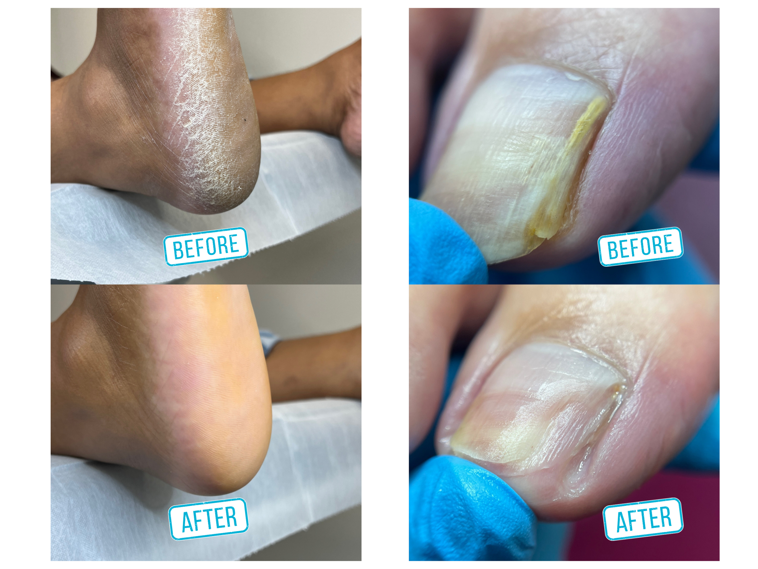 Comparison of toenails before and after a treatment. The 'before' images show thick, discolored, and damaged toenails, while the 'after' images show clearer, healthier-looking toenails with improved texture.