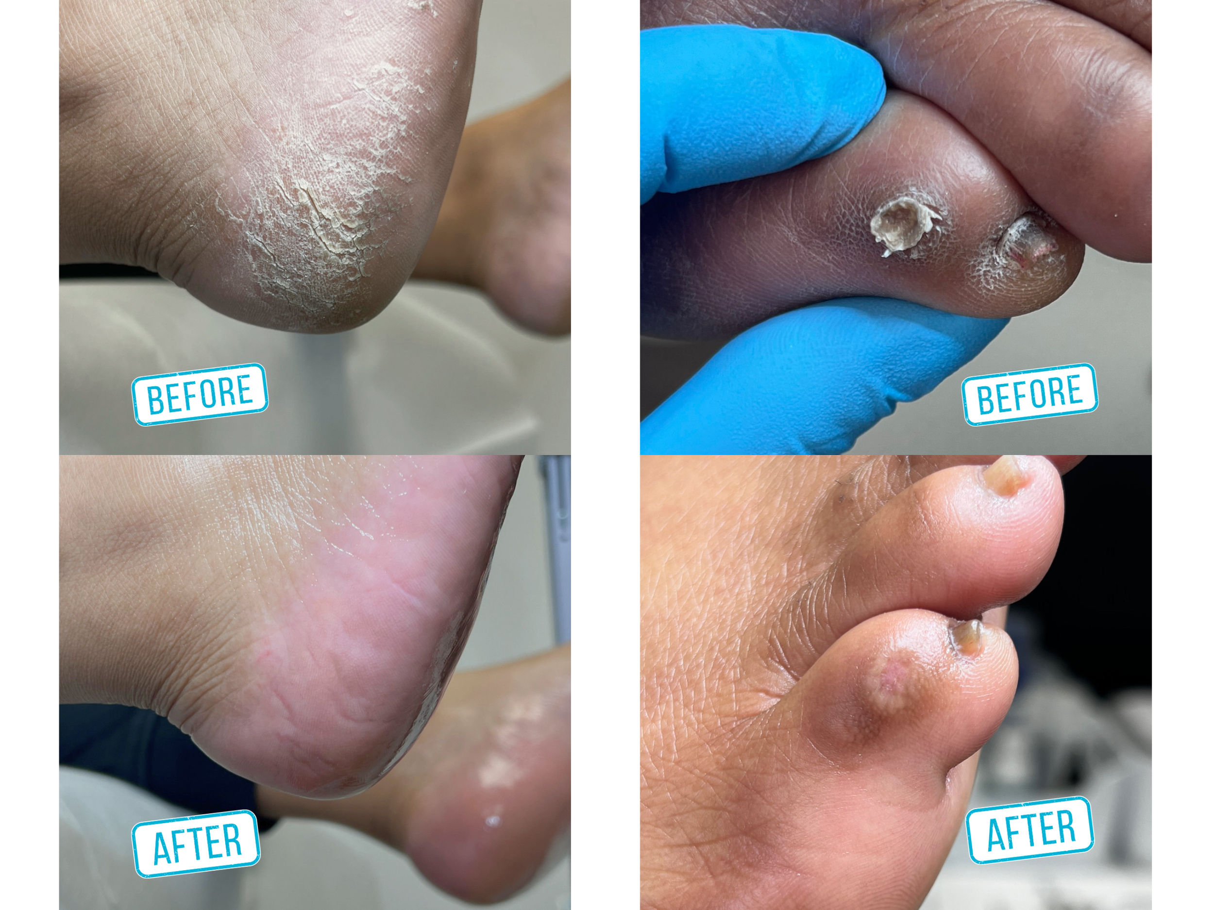 Side-by-side comparison of toes with before and after treatments. The top left image shows dry, cracked skin on a toe with a "BEFORE" label, while the top right image shows a toe with removed calluses and healthier skin, labeled "AFTER." The bottom i