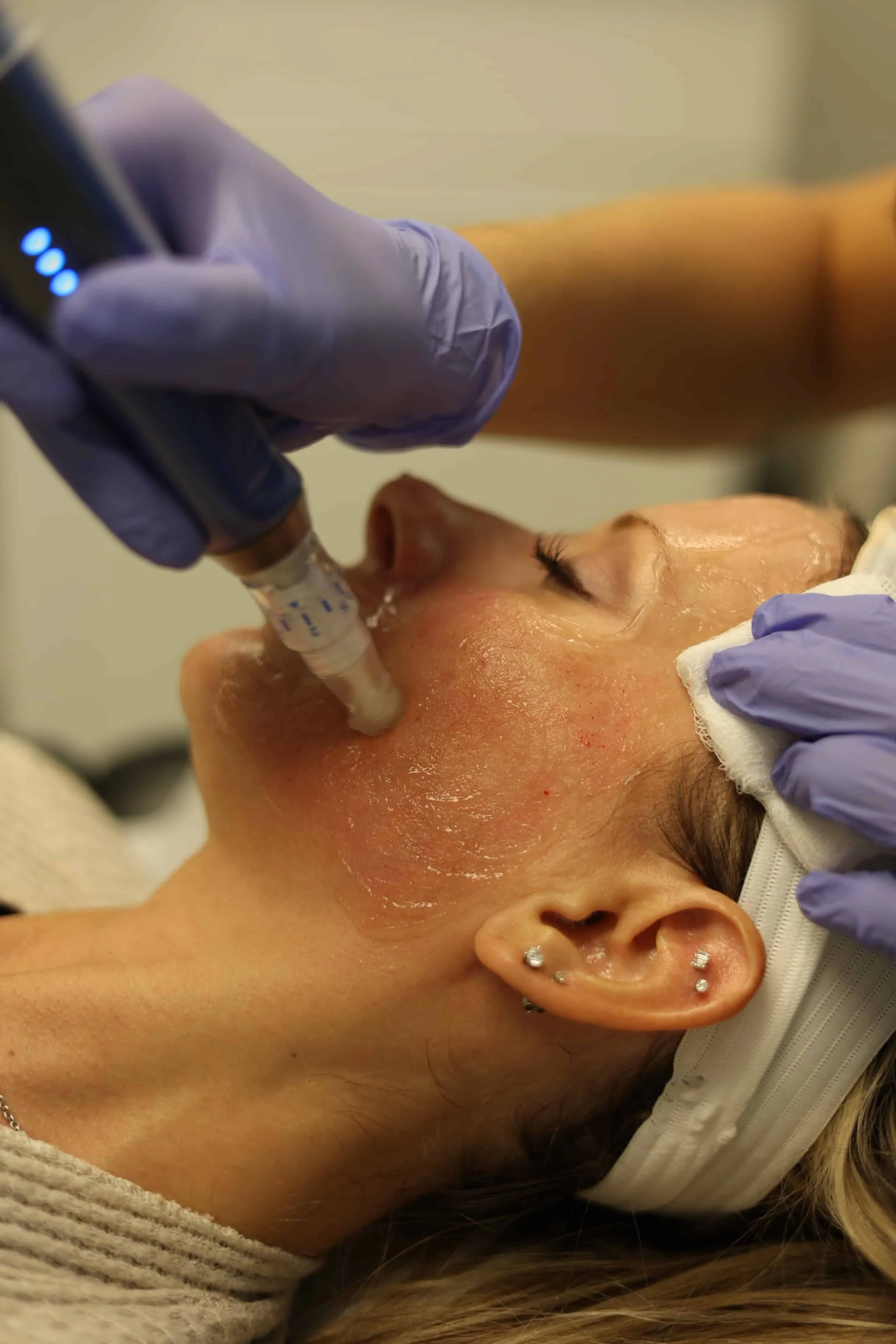 Microneedling: A Prickly Path to Perfect Skin