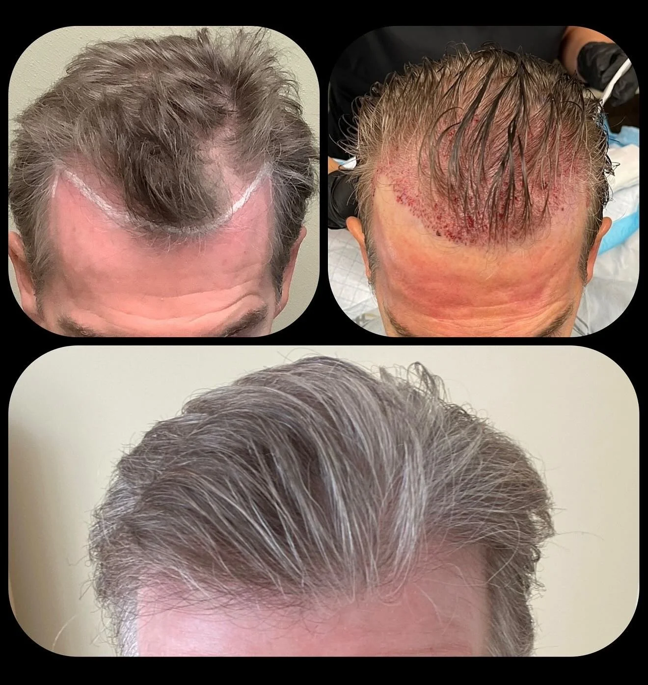 🌱 SmartGraft is a modern hair restoration treatment that uses your own hair to restore natural growth. No wigs, no cover-ups, just fuller, healthier hair that&rsquo;s here to stay. Book your consultation today at www.drdavidrosner.com/book

The bene