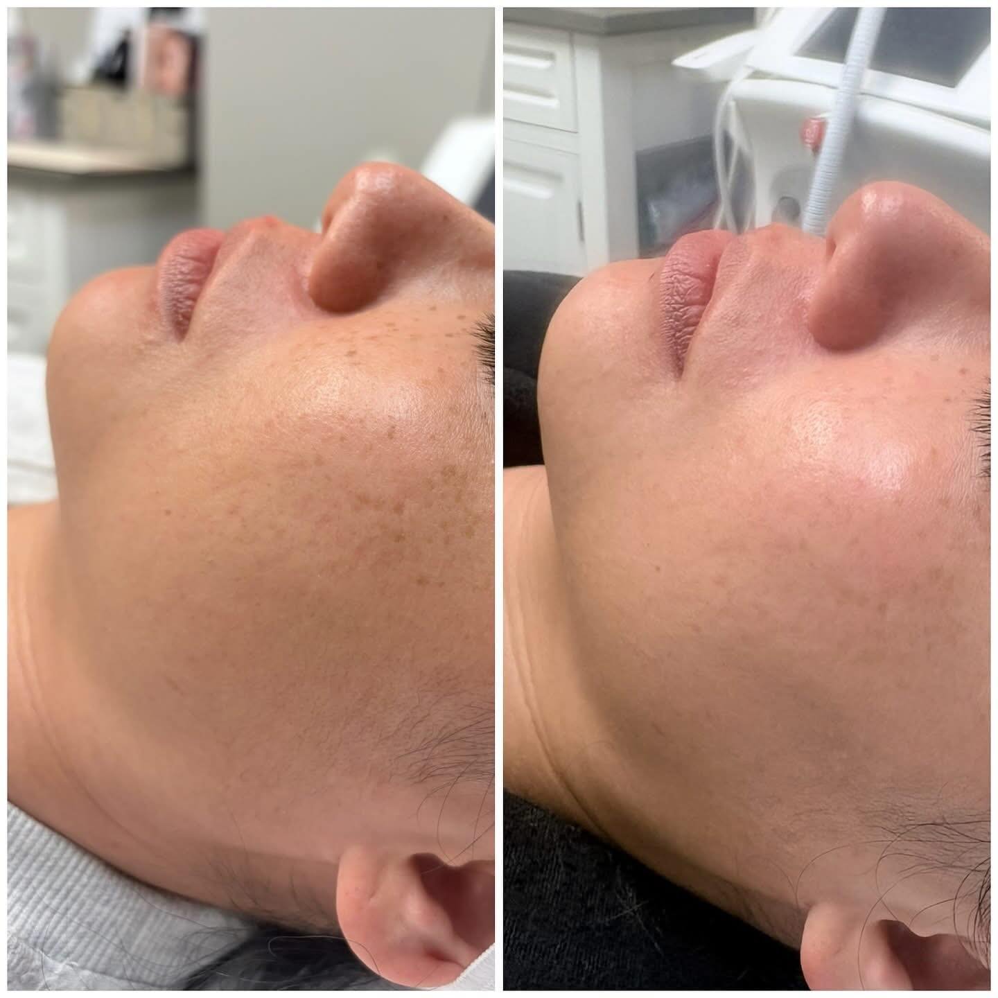 IPL season😍 
This is after just one session!! 
✨ Improved overall glow
🌿 Reduced pigmentation/freckling
🌸 Less redness &amp; dullness