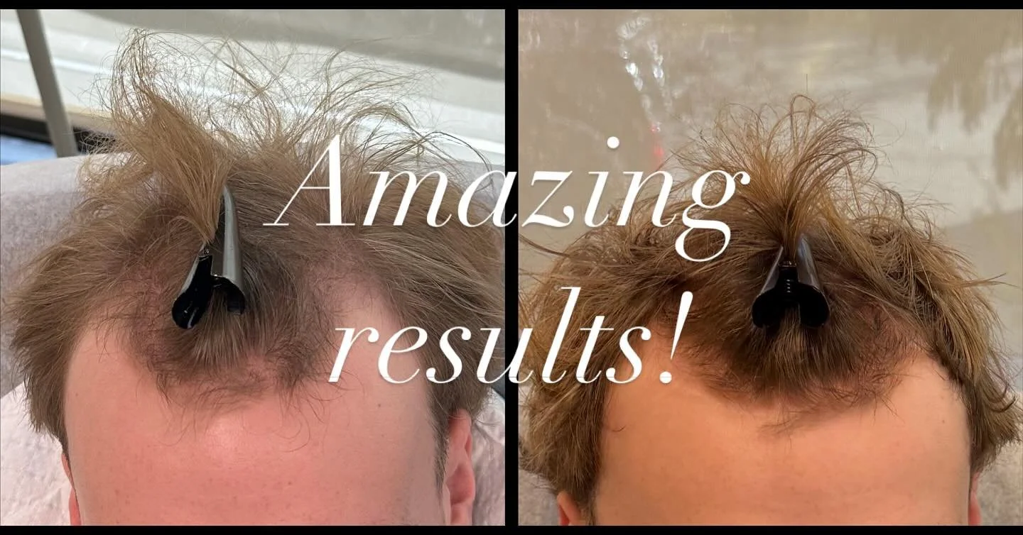 💥 Great results without surgery! This patient had two PRP (Platelet-Rich Plasma) treatments along with using Remedy's prescription hair serum and daily @nutrafol use. 

#morehair#nutrafol#prphairrestoration#getyourhairback