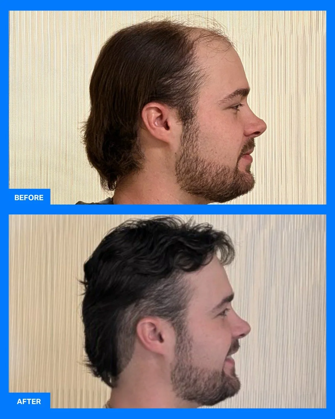 Instant confidence without surgery. At Remedy+, we have custom hair systems designed for natural results. Call 616-214-7228 to see if this is a good option for you.

What it is: Custom-designed non-surgical hair systems provide immediate fullness and