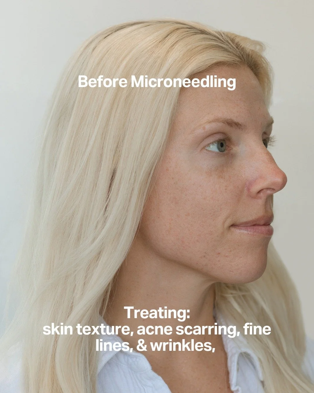 Next-level skin renewal with Microneedling and exosomes. Call 616-214-7228 or book online. Link in bio.

✨What is Microneedling? Microneedling enhanced with exosomes accelerates repair and rejuvenation by creating micro-channels in your skin. Exosome