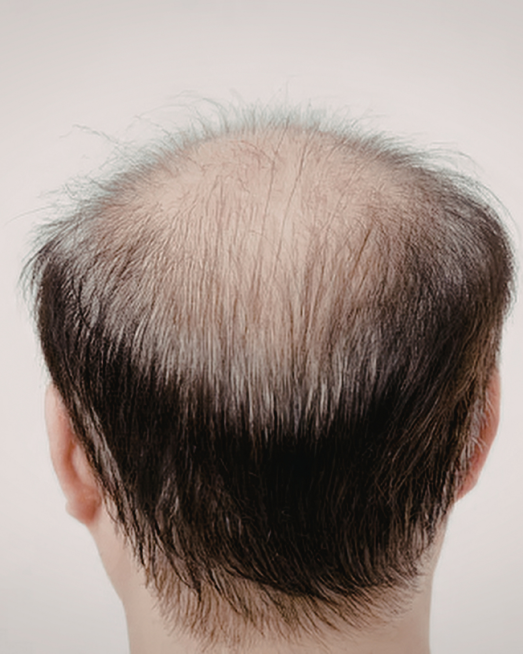 Why Your Hair Is Thinning: 7 Hidden Causes of Hair Loss (And How to Fix Them)