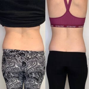 Body-Contouring-at-Remedy-3.jpeg