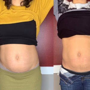 Body-Contouring-at-Remedy-2.jpeg