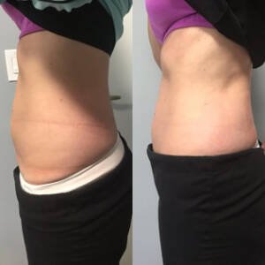 Body-Contouring-at-Remedy-8.jpeg