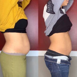 Body-Contouring-at-Remedy-4.jpeg