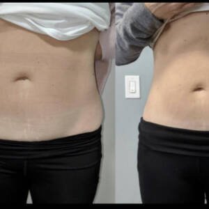 Body-Contouring-at-Remedy-14.jpeg