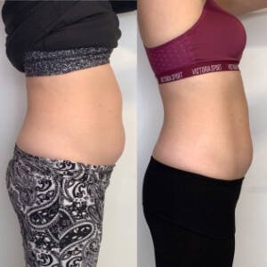 Body-Contouring-at-Remedy-5.jpeg