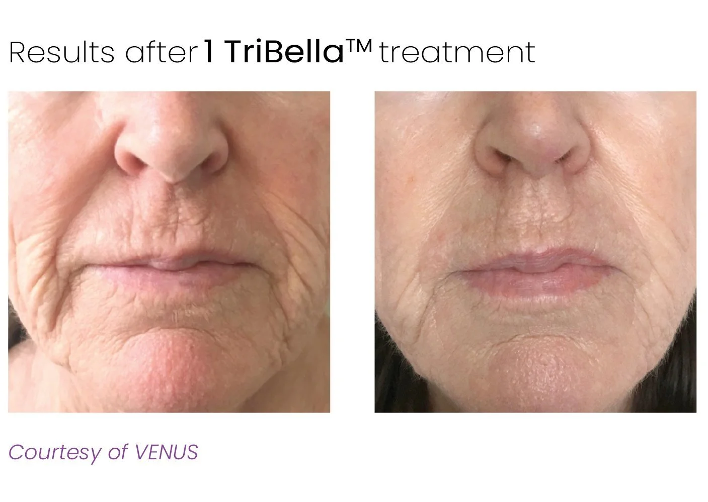 Versa_TriBella-B&A-4.jpg