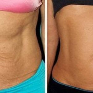 Body-Contouring-at-Remedy-6.jpeg