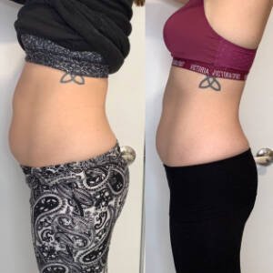 Body-Contouring-at-Remedy-1.jpeg