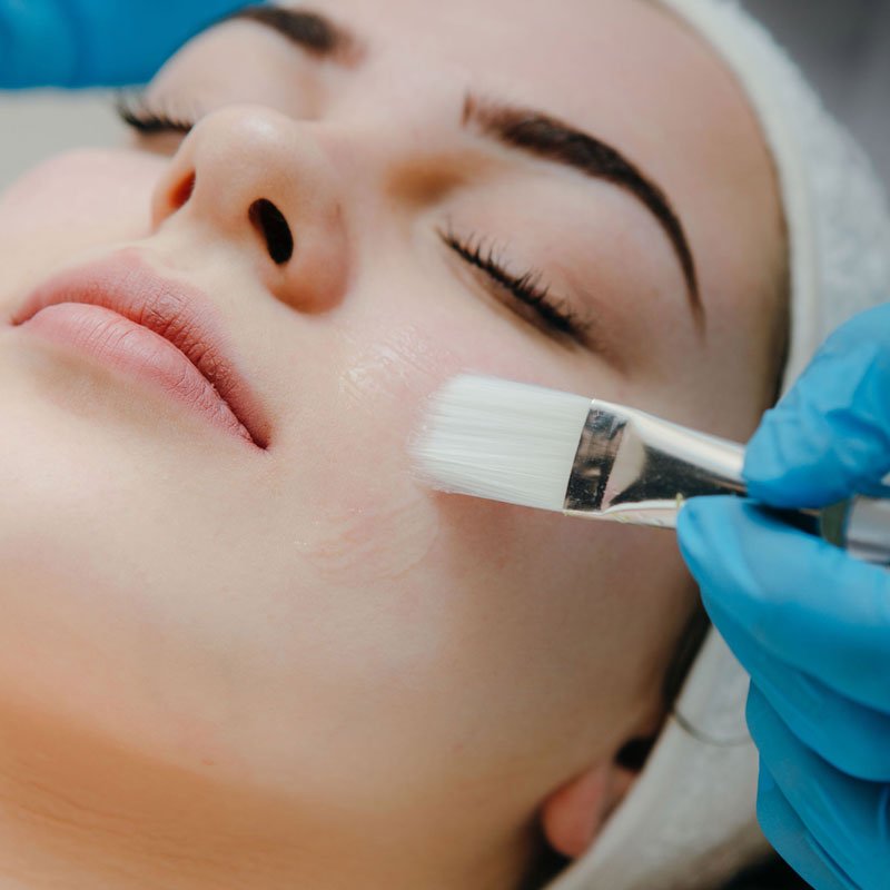 Chemical Peel