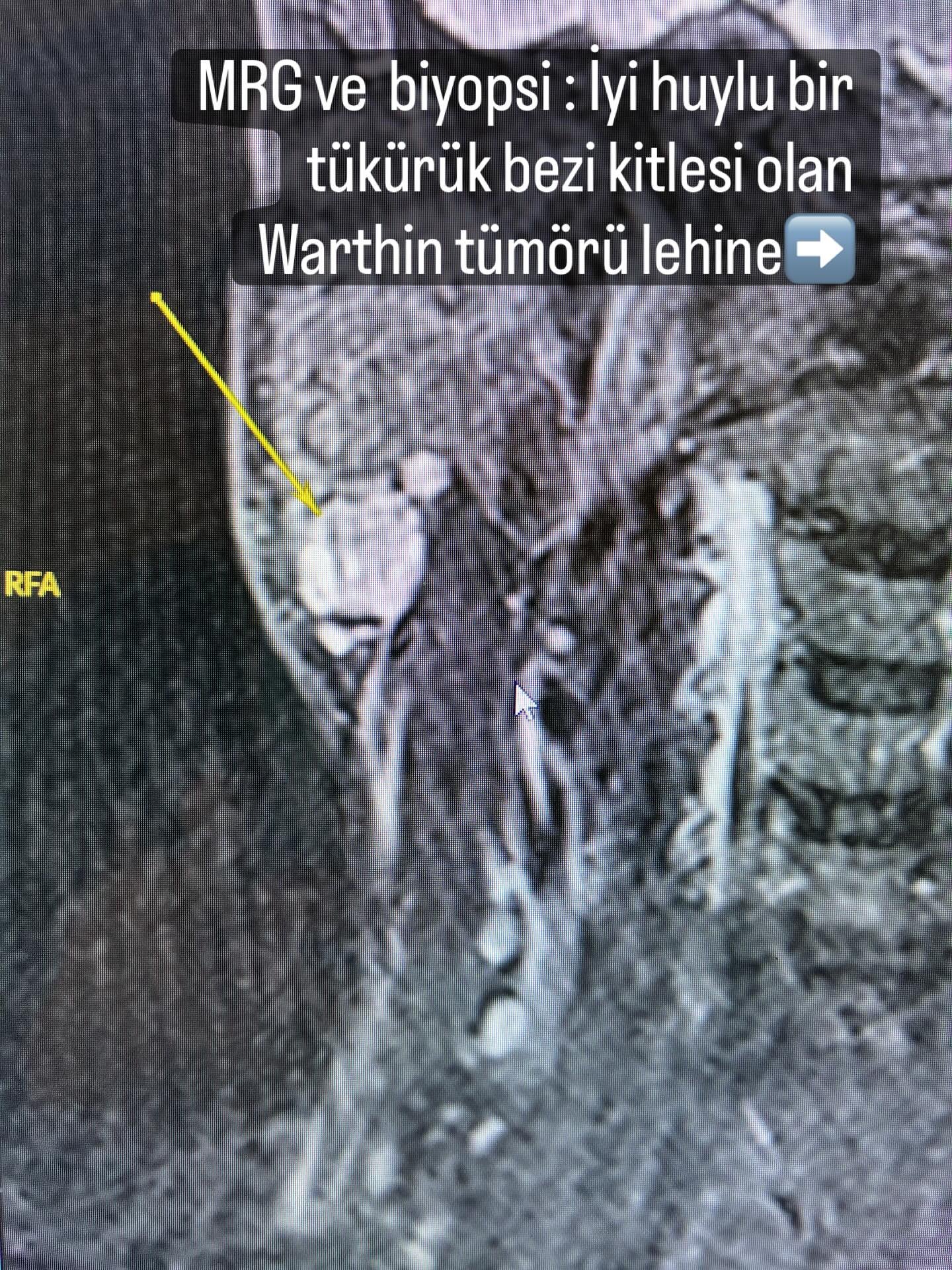 Yanakta şişlik parotis bezi kitlelerinden kaynaklanabilir. G&ouml;r&uuml;nt&uuml;leme y&ouml;ntemleri ve biyopsi bize yol g&ouml;sterir. Şişliğin sebebinin parotis kitlesi olduğu anlaşılırsa g&uuml;venli sınırlarla &ccedil;ıkarılması hem tanı hem de 